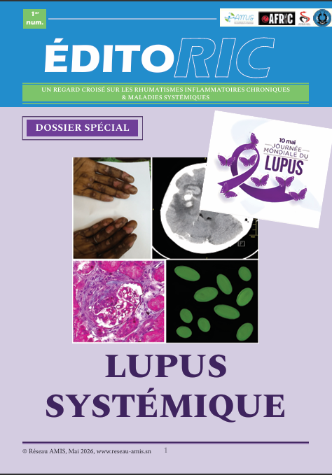 Lupus